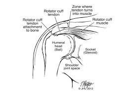 You can see these areas marked with an x in the shoulder anatomy diagram above. Partial Rotator Cuff Tear Johns Hopkins Medicine