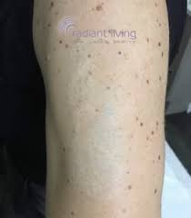 Do not pick the scabs, blisters, or crusts that form after your laser tattoo removal treatment. Will Laser Tattoo Removal Leave A Scar Here S Your Answer