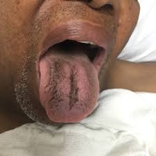 Image result for black hairy tongue symptoms