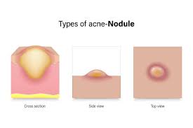 Image result for Nodule