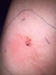 Ingrown hairs happen when a shaved or plucked hair begins to grow back in under the skin instead of emerging from the follicle. Ingrown Hairs On Buttocks And Legs Ingrown Hair