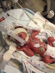 I have actually known this since i became a mom to a preemie. Ten Inspiring Premature Baby Stories Medela