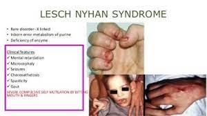 Lesch Nyhan Syndrome Physiology And Features