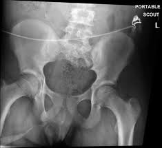 Technique, retrograde urethrogram vs cystogram vcug, vcug girls, vcug boys, vcug test, vcug female, vcug is your child due for a vcug? Principles Of Voiding Cystourethrography Vcug Springerlink