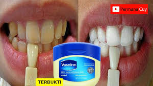 Cara perawatan untuk gigi kuning. Hanya Dalam 3 Menit Gigi Kuning Menjadi Putih Bersinar Youtube