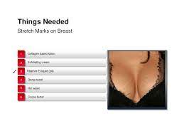 Stretch Marks On Breast How To Remove Them