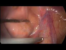 Video of diagnostic laparoscopy for trauma, tuberculosis and infirtility. Male Pelvic Anatomy In Laparoscopy Youtube