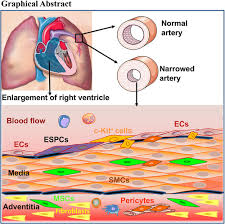Also, it is located beside a public market. Stem Progenitor Cells And Pulmonary Arterial Hypertension Arteriosclerosis Thrombosis And Vascular Biology