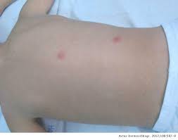 Prin urmare, persoanele susceptibile ar trebui să evite contactul cu persoanele care. Disseminated Herpes Zoster After Varicella Vaccination In A Healthy Boy Actas Dermo Sifiliograficas