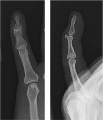 Take time to recover ! The Hand