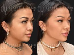 Asian rhinoplasty