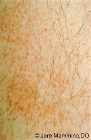 Well you're in luck, because here they come. Progressive Pigmentary Purpura American Osteopathic College Of Dermatology Aocd