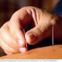 Acupuncture from www.mayoclinic.org