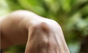 There is no difference in recurrence rate or survival time when a simple versus a radical mastectomy is performed. Soft Tissue Sarcoma What You Need To Know About This Rare Cancer Medanta