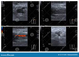 Doppler Ultrasound Diagnosis And Classification As An Alternative To  Arteriography - D.E. Fitzgerald, J. Carr, 1975
