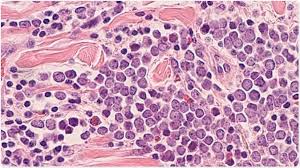 Cancer records show that doctors diagnosed about 2,000 mccs in the united states during 2018.1. New Study Provides A Better Understanding Of Merkel Cell Carcinoma