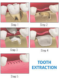 We did not find results for: Tooth Removal Diamond Dental Clinics