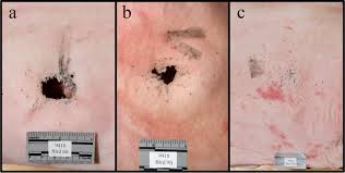 The latest tweets from buckshot (@buckshot). The Difficulties In Assessing Wounds Created By 410 Bore Ammunition And Weapons Hlavaty 2020 Journal Of Forensic Sciences Wiley Online Library