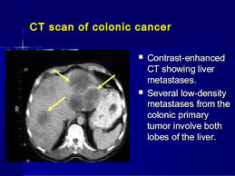 It is the second most. Abdominal Ct Scan Colon Cancer Ct Scan Machine