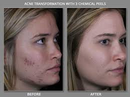 Safe & Natural Acne Treatments