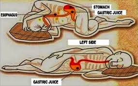 Try eating prunes or drinking prune juice and drink plenty of as soon as i came off the co codamols i had no trouble. What Side To Sleep After Gallbladder Surgery Quora