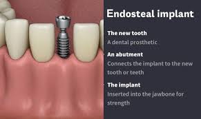 Image result for dental implant