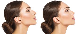 Rhinoplasty in Austin, TX