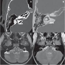 Bilateral Large Vestibular Aqueduct Syndrome In An 11 Year Old Boy Radiological And Clinical Findings Semantic Scholar