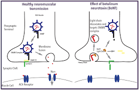 Botulism is caused by nerve toxins made by clostridium botulinum bacteria. Annals Of B Pod Infantile Botulism Taming The Sru