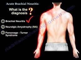 Brachial Plexus Neuritis Parsonage Turner Everything You Need To Know Dr Nabil Ebraheim Youtube