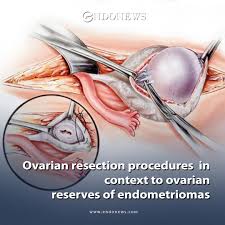 This Systematic Review And Meta Analysis Explore The Impact Of Unilateral Versus Bilateral Ovarian Endometrioma On Ovarian Reser Ovarian Hormones Meta Analysis