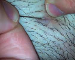 Here's how to get rid of them without a trip to the doctor. Massive Ingrown Hair Removal Viral On The Web Now