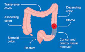 Maybe you would like to learn more about one of these? Understanding Colon Cancer Screening Gastrointestinal Diseases Inc Columbus Ga