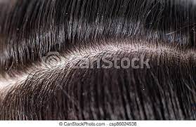 Then, apply directly to the scalp of wet hair and massage in gently. Scales Of Dandruff In A Man S Black Hair The Concept Of Getting Rid Of Dandruff And Hair Care Background Macro Scales Of Canstock