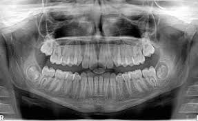 The lowest radiation exposure to cause radiation sickness is about 100 rem (1 sv). Concerned About Radiation From Dental X Rays Don T Be