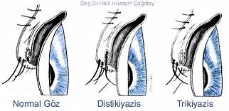 Kirpiklerin Goze Batmasi Trikiyazis Distikiyazis Tani Ve Tedavi