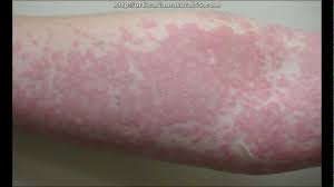 Emuaid.com has been visited by 100k+ users in the past month Antihistamine Medicine For Hives