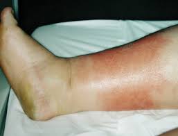 Image result for erysipel photos)