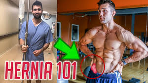 Image result for Inguinal hernia man