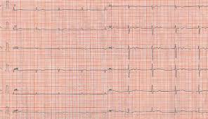 But the culture had no growth. Cardiac Metastases Of Malignant Melanoma Mimicking Sick Sinus Syndrome Revista Espanola De Cardiologia