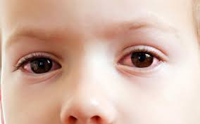 The symptoms of eye cancer are similar to migraines and other eye issues, so it can be challenging to detect eye cancer in its early stages. Pink Eye In Toddlers Symptoms Diagnosis And Treatment