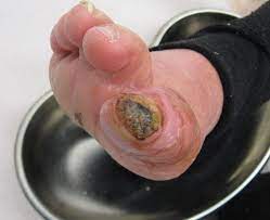 Check spelling or type a new query. Diabetic Foot Ulcers Classification Systems