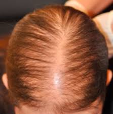 This isn't painful and it tends to have quite a rubbery feel. Alopecias In Lupus Erythematosus Lupus Science Medicine