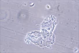 Influence of bacterial vaginosis on conception and miscarriage in the first trimester: Effective Treatment Of Recurrent Bacterial Vaginosis Mdedge Obgyn