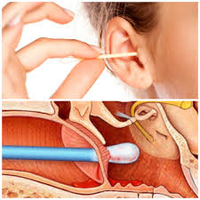Telinga berdengung sebelah kiri adalah gejala ringan tinnitus. Radang Telinga Otitis Externa Klinik Awfa Kotasas