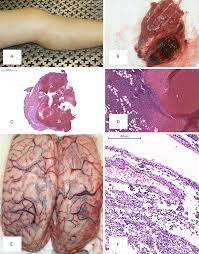 PDF] Meningitis and pneumococcal pyomyositis in a child with intramuscular  hemangiomas: an autopsy case report. | Semantic Scholar