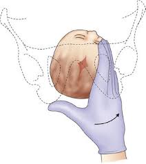 Image result for Manual Rotation in Occipitoposterior Presentation