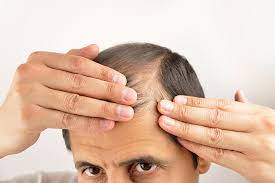 Understanding the symbolism of hair. 4 Ways To Know If You Re Going Bald Hair Transplant