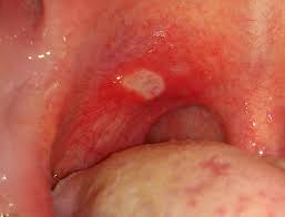 White Spots On Back Of Throat Meaning Cancer No Pain Std Strep Pictures Lump Patches Treatment White Spots On Body Pinterest