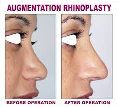 Rhinoplasty Surgery In Jalandhar Punjab India Rhinoplasty Surgery Rhinoplasty Nose Surgery